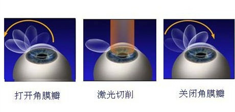 英國政府禁止眼睛激光手術 易視界