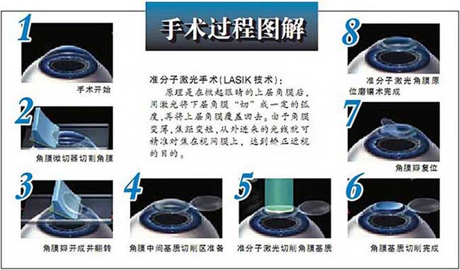 英國政府禁止眼睛激光手術 易視界