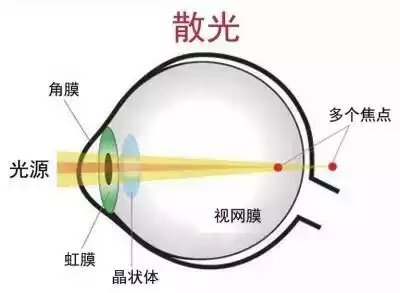易視界護(hù)眼專(zhuān)家為您講解什么是散光