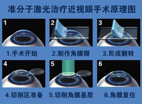 激光手術(shù)過程