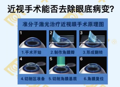 近視手術(shù)能否去除眼底病變？