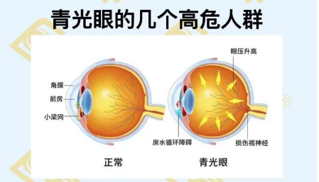青光眼的幾個(gè)高危人群？