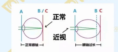 哪個(gè)年齡近視度數(shù)最容易增長？
