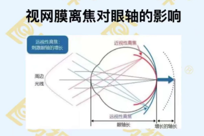 視網(wǎng)膜離焦對(duì)眼軸的影響