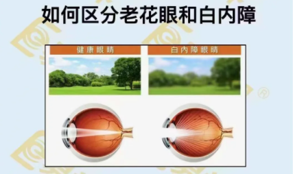 如何區(qū)分老花眼和白內(nèi)障？
