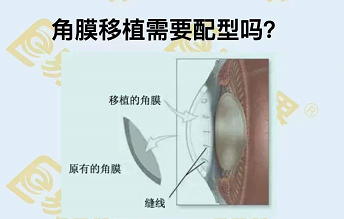 角膜移植需要配型嗎？