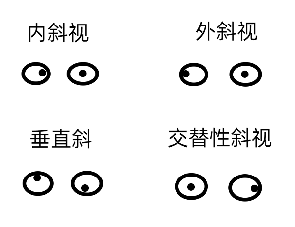 斜視早期的癥狀有哪些？